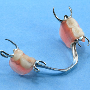 Chromium removable partial denture on blue background