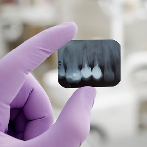 Dental xray