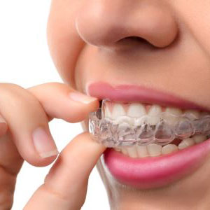 Invisalign braces from dentist in Buffalo