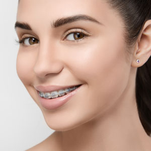 Beautiful girl smiling looking on a camera with braces on white teeth